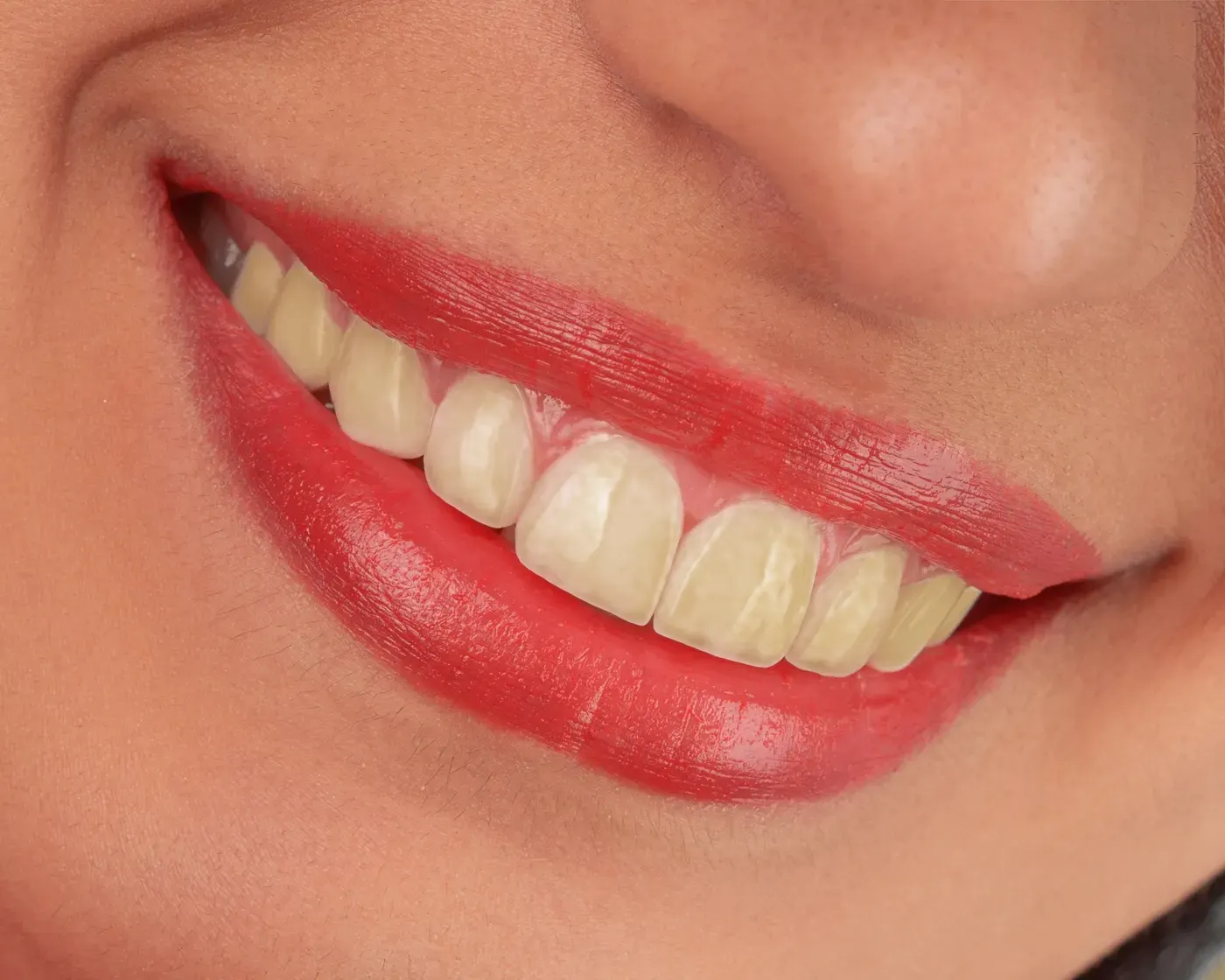 Lo stesso sorriso prima dello sbiancamento