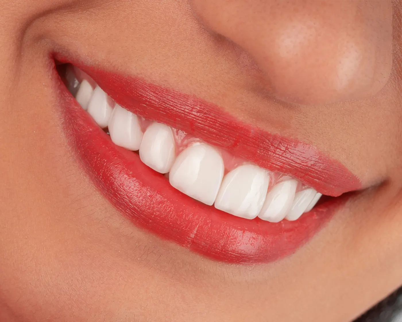 Sorriso dopo lo sbiancamento